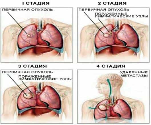 стадии рака