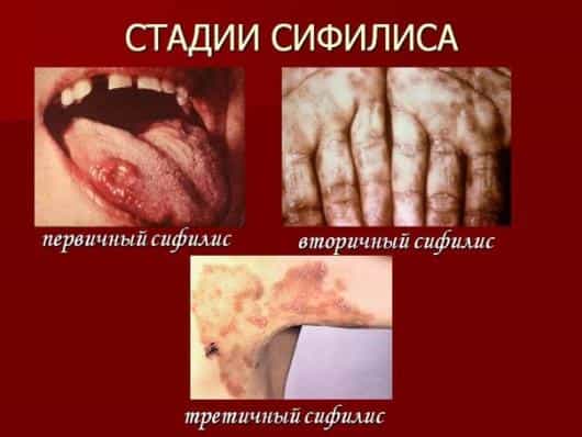 Три стадии сифилиса