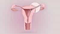 Essure