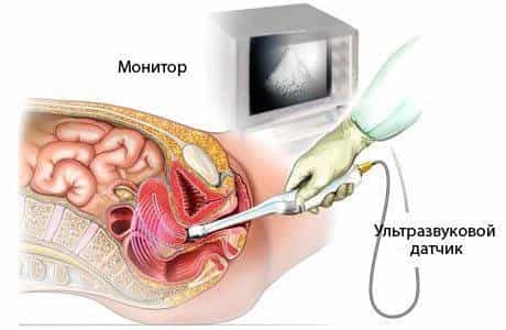 трансвагинальное узи