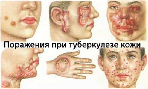 туберкулез кожи