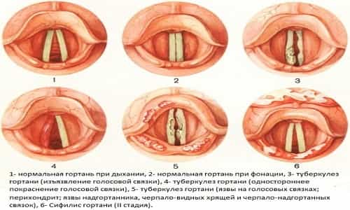 туберкулез гортани