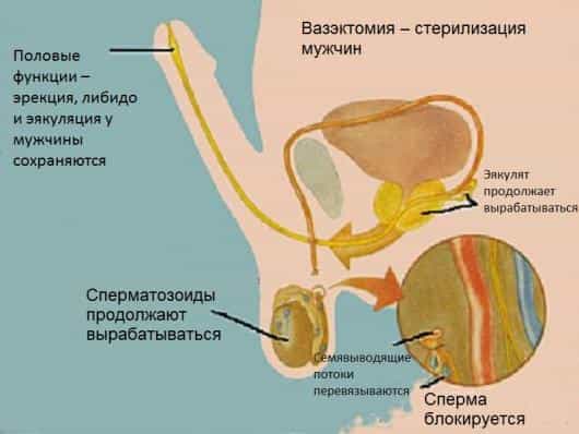 вазэктомия