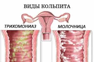 виды кольпита
