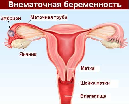 внематочная беременность