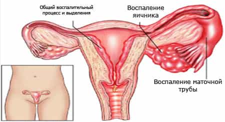 воспаление яичников