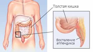 воспаление аппендикса
