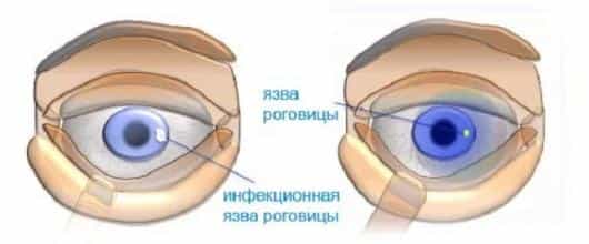 инфекционная язва