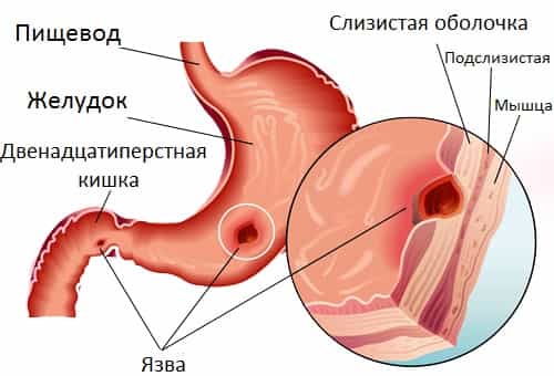 язва желудка
